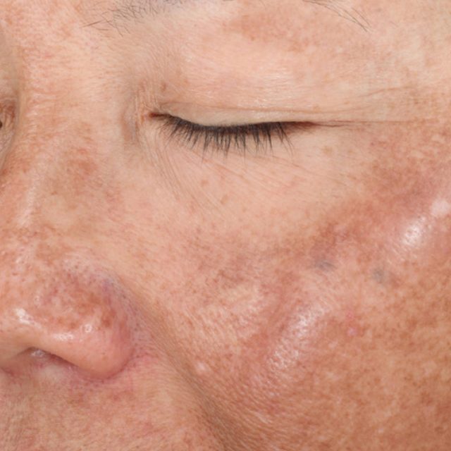 Closeup of left side of a woman's face region.