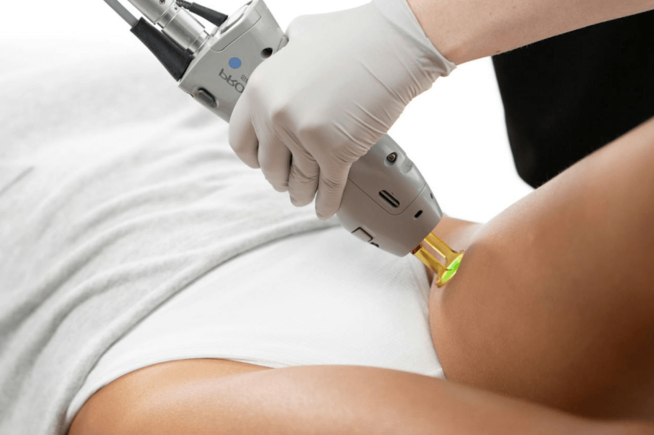 Laser Hair Removal treatment